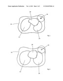 Apparatus for Respiration State Gated Brachytherapy diagram and image