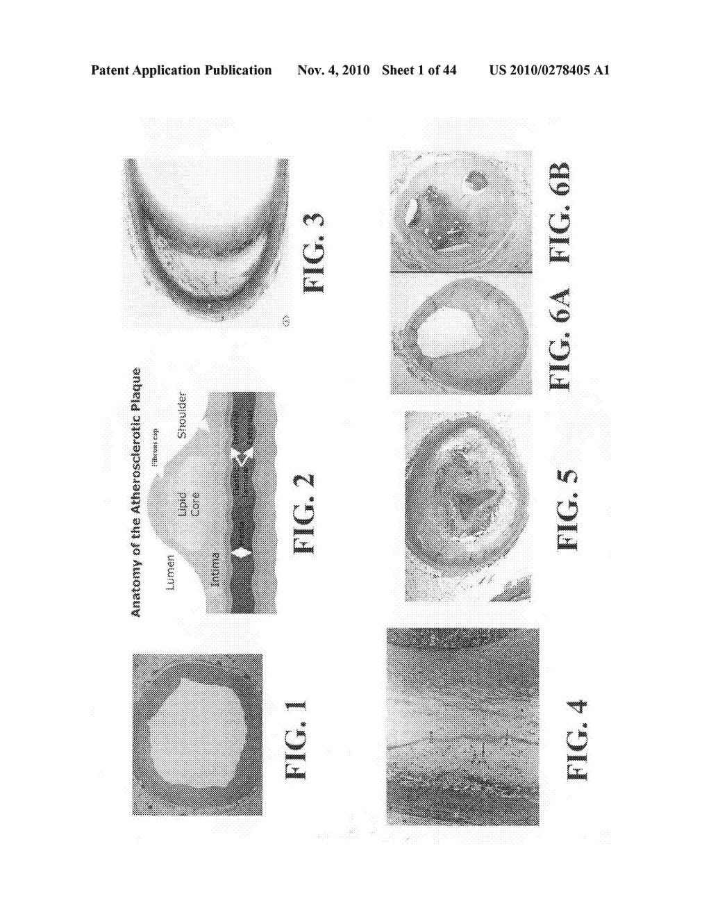 Scoring Method for Imaging-Based Detection of Vulnerable Patients - diagram, schematic, and image 02