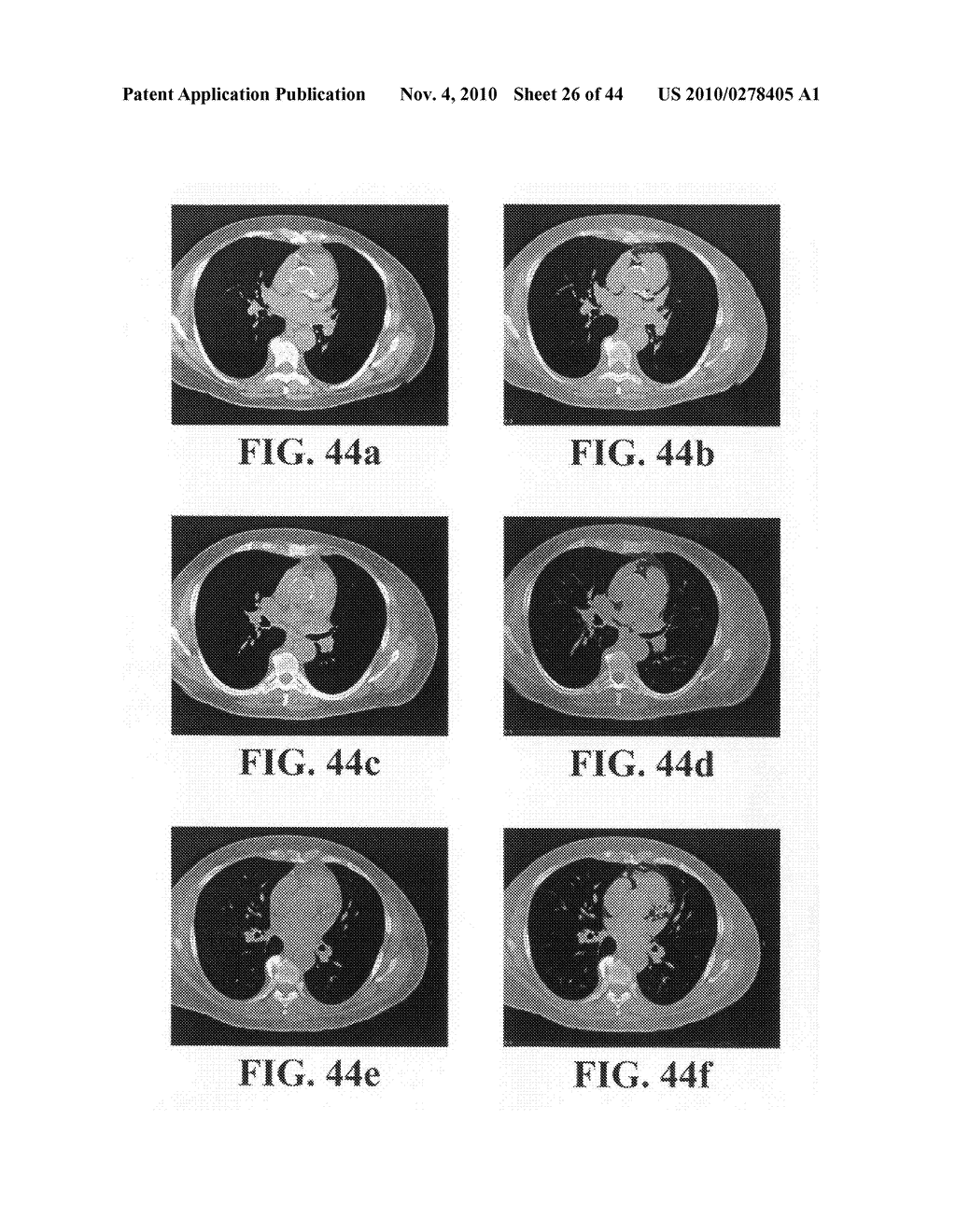 Scoring Method for Imaging-Based Detection of Vulnerable Patients - diagram, schematic, and image 27