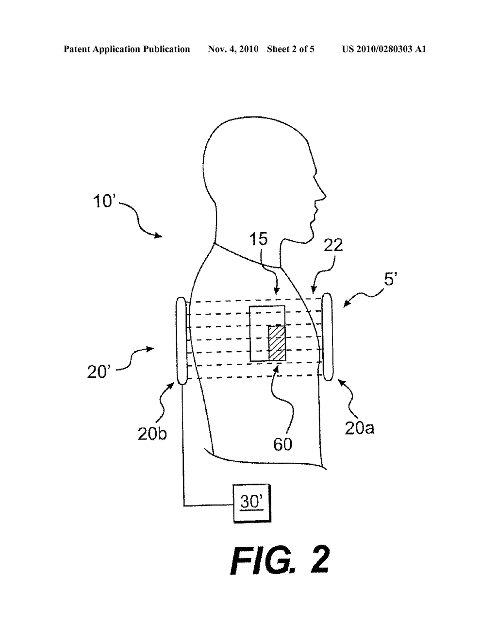 DEVICES AND METHODS FOR TREATING MAGNETIC POISONING AND/OR MAGNETICALLY INDUCED ROULEAUX - diagram, schematic, and image 03