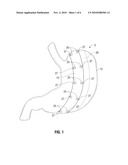 Magnetic Gastric Reduction Device diagram and image