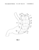 Magnetic Gastric Reduction Device diagram and image