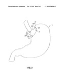 Magnetic Gastric Reduction Device diagram and image