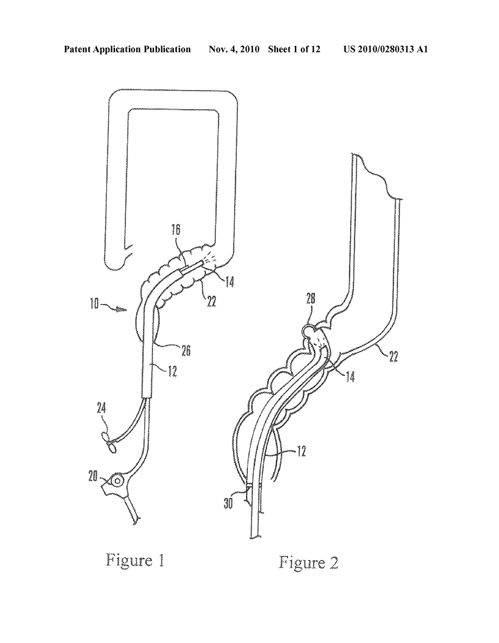 SYSTEMS AND METHODS FOR ENDOSCOPIC INVERSION AND REMOVAL OF DIVERTICULA - diagram, schematic, and image 02