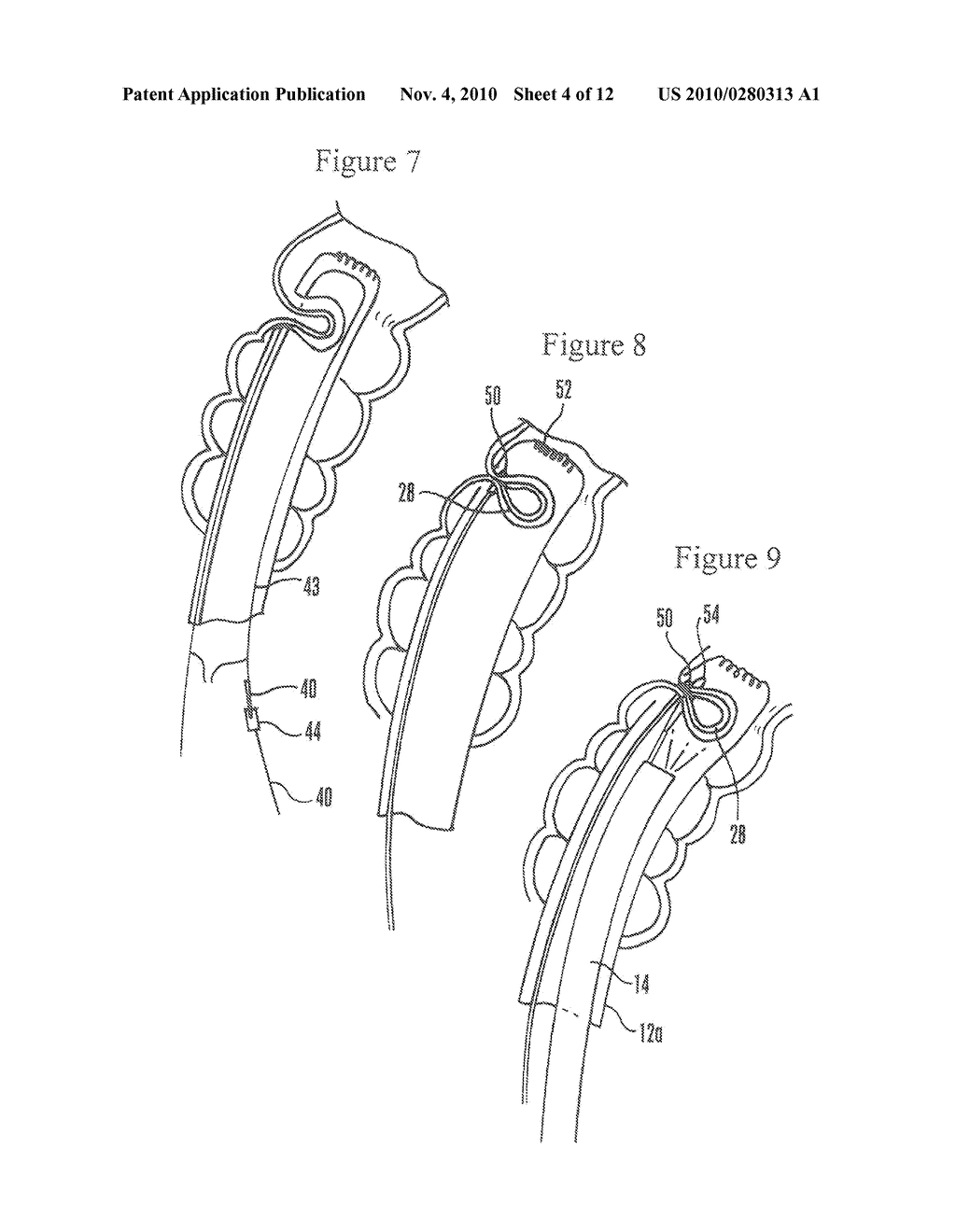 SYSTEMS AND METHODS FOR ENDOSCOPIC INVERSION AND REMOVAL OF DIVERTICULA - diagram, schematic, and image 05