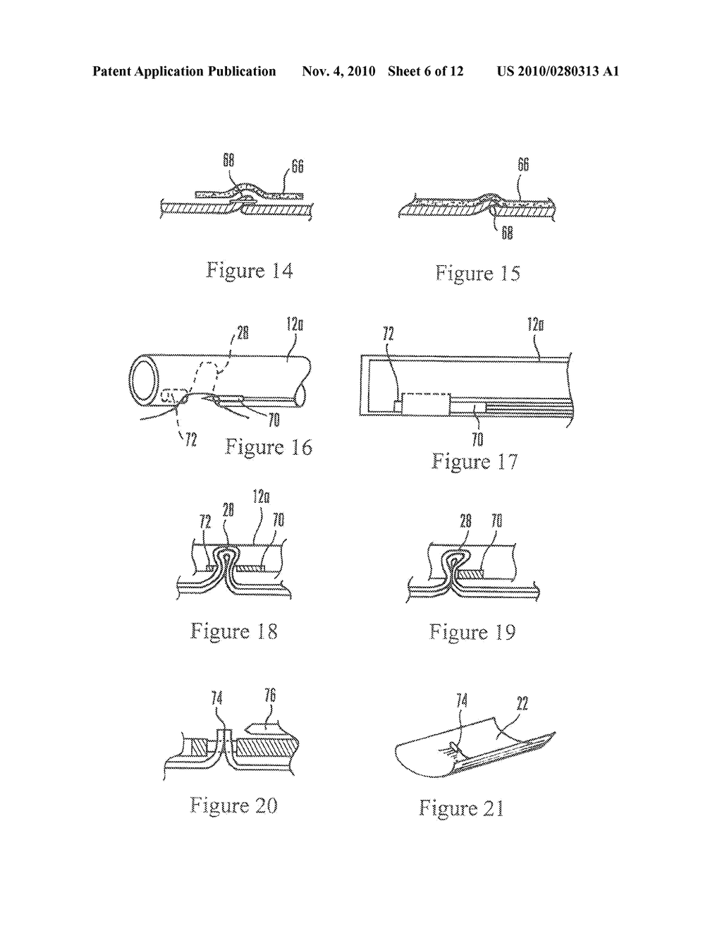 SYSTEMS AND METHODS FOR ENDOSCOPIC INVERSION AND REMOVAL OF DIVERTICULA - diagram, schematic, and image 07