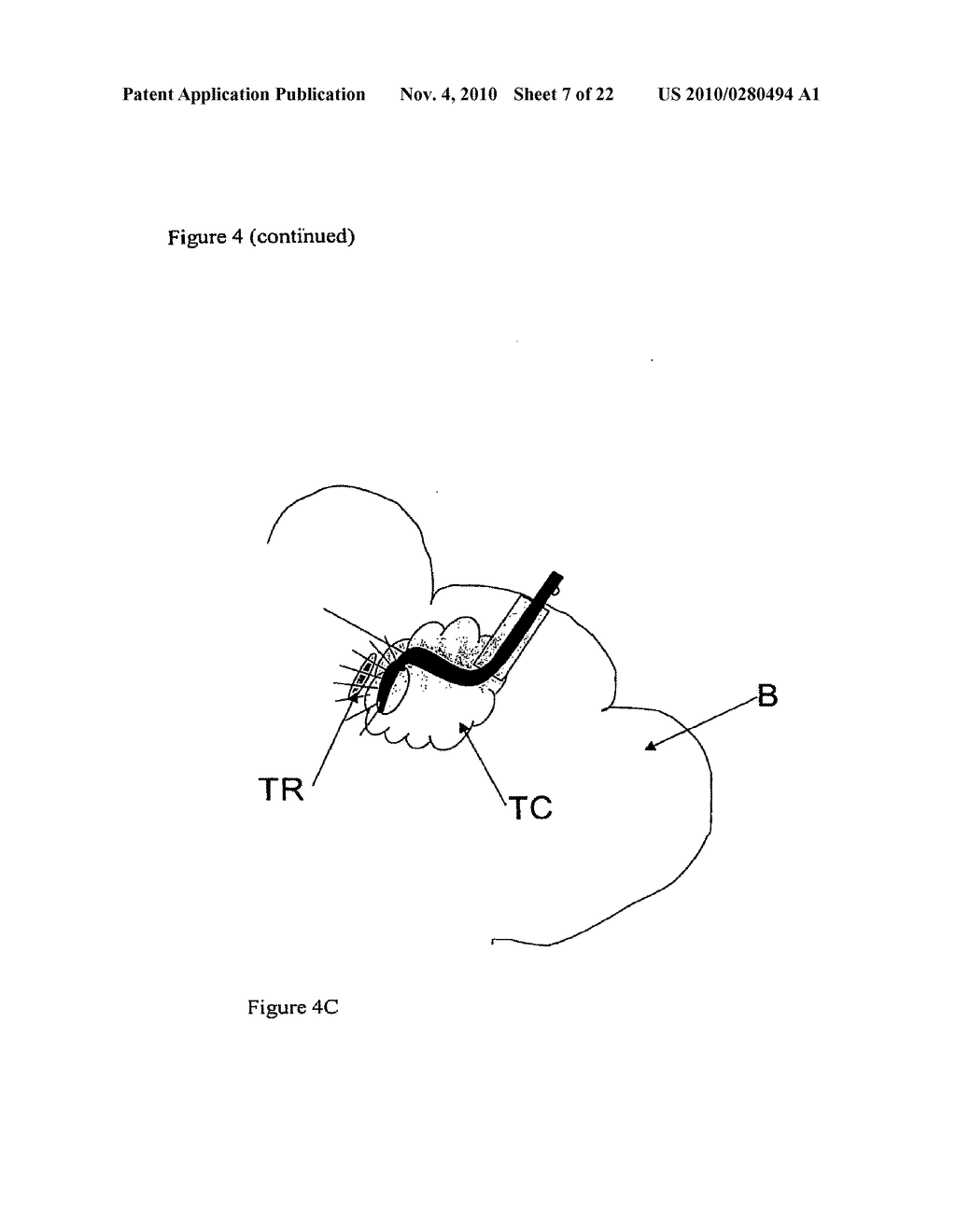 CATHETER AND ARRAY FOR ANTICANCER THERAPY - diagram, schematic, and image 08