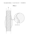 DRAWSTRING FOR REMOVAL OF STENT diagram and image