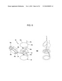 DRAWSTRING FOR REMOVAL OF STENT diagram and image