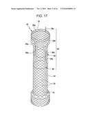 DRAWSTRING FOR REMOVAL OF STENT diagram and image