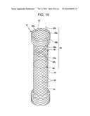 DRAWSTRING FOR REMOVAL OF STENT diagram and image