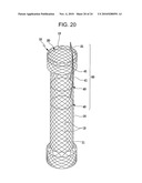 DRAWSTRING FOR REMOVAL OF STENT diagram and image