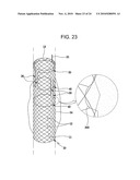 DRAWSTRING FOR REMOVAL OF STENT diagram and image