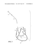 Mitral Valve Device Using Conditioned Shape Memory Alloy diagram and image