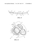 Mitral Valve Device Using Conditioned Shape Memory Alloy diagram and image