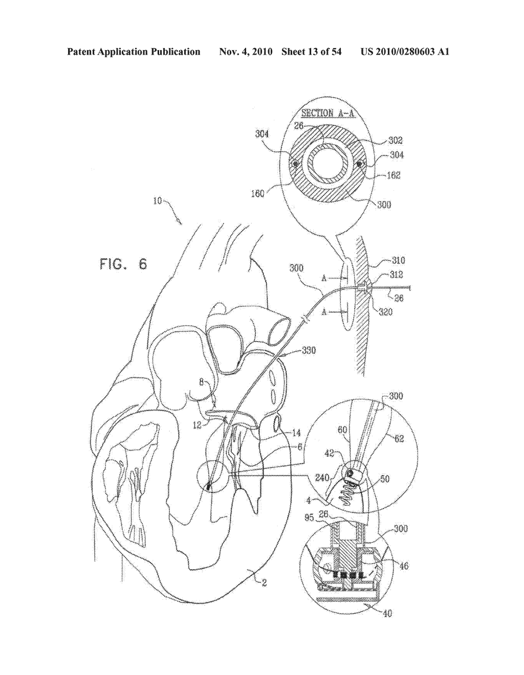 IMPLANTATION OF REPAIR CHORDS IN THE HEART - diagram, schematic, and image 14