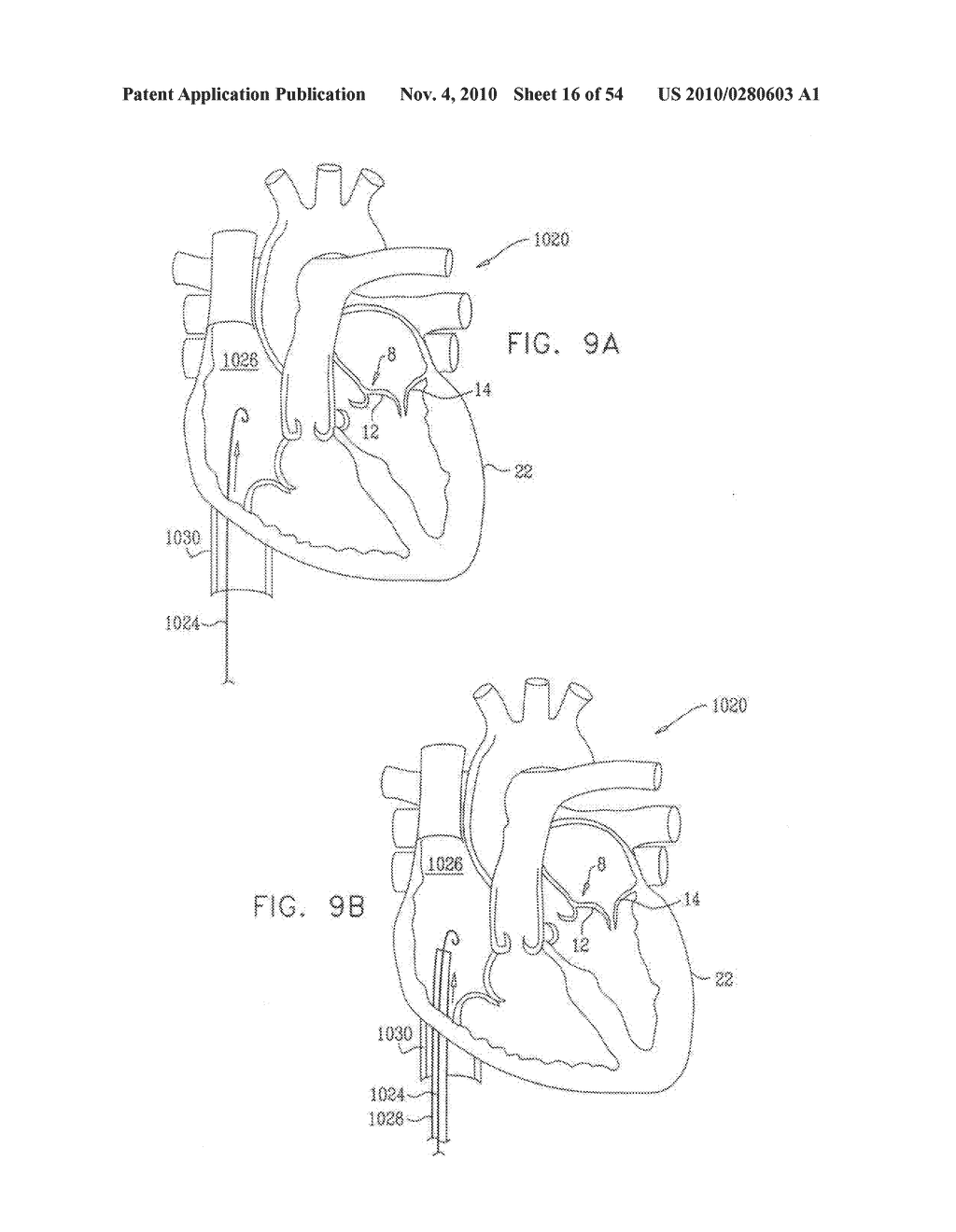 IMPLANTATION OF REPAIR CHORDS IN THE HEART - diagram, schematic, and image 17