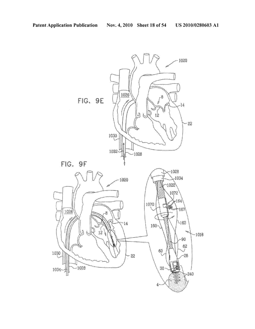 IMPLANTATION OF REPAIR CHORDS IN THE HEART - diagram, schematic, and image 19