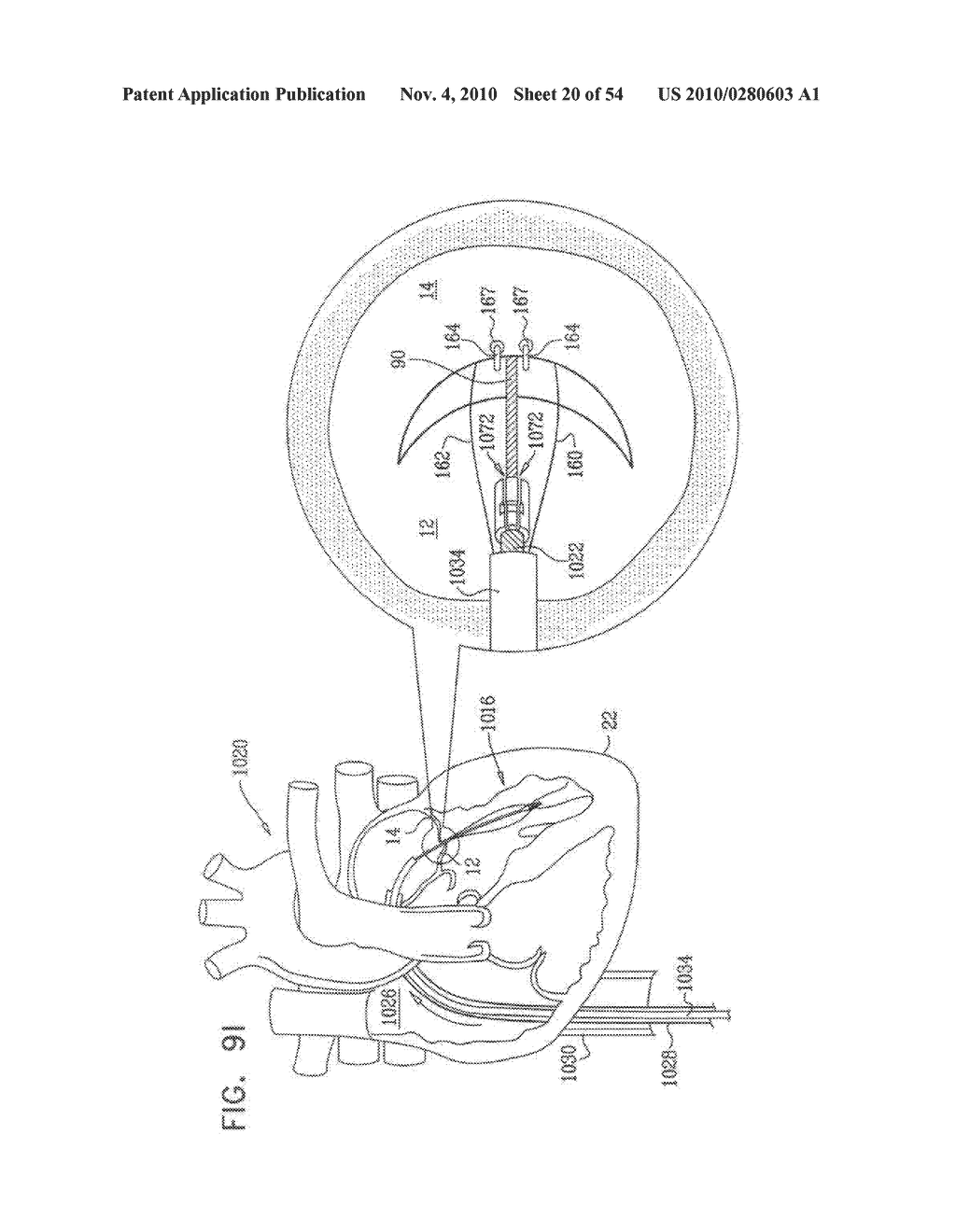 IMPLANTATION OF REPAIR CHORDS IN THE HEART - diagram, schematic, and image 21