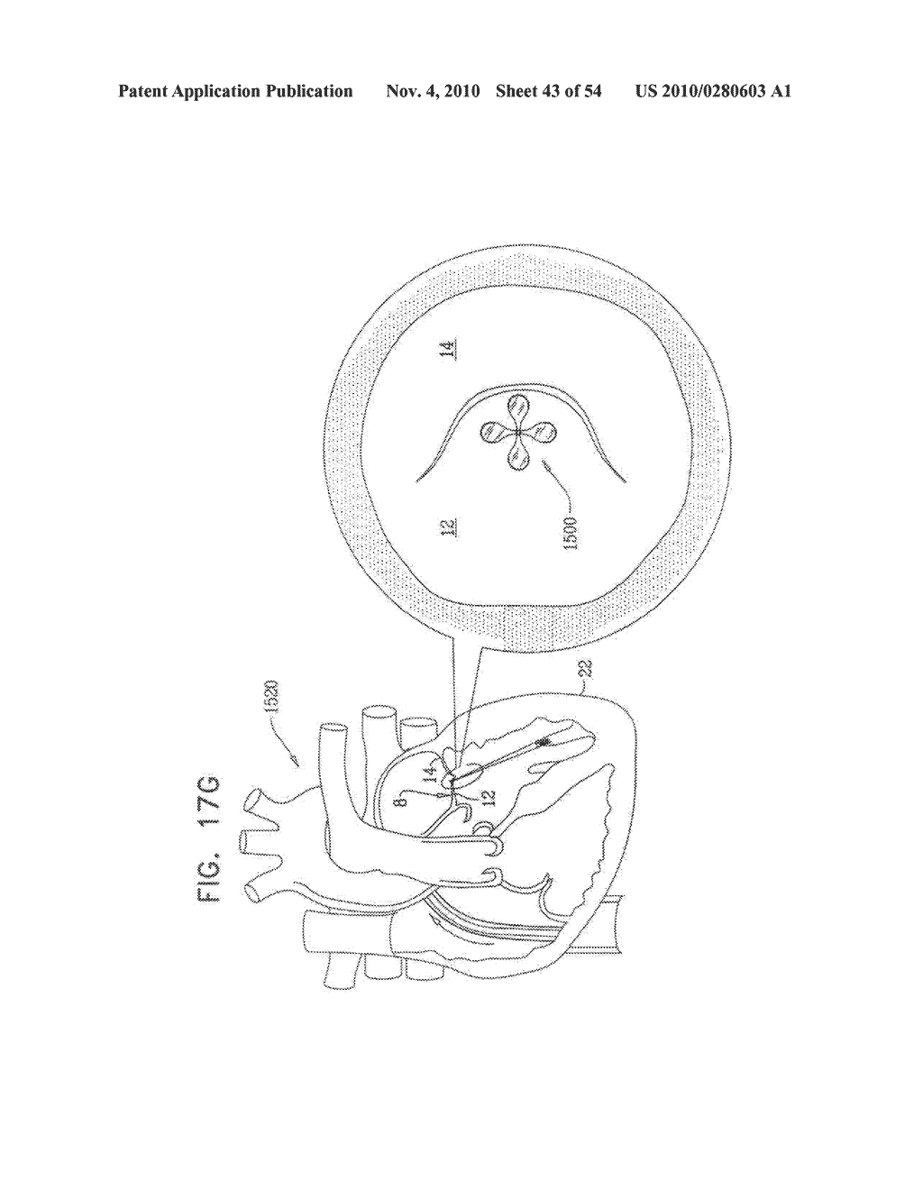 IMPLANTATION OF REPAIR CHORDS IN THE HEART - diagram, schematic, and image 44