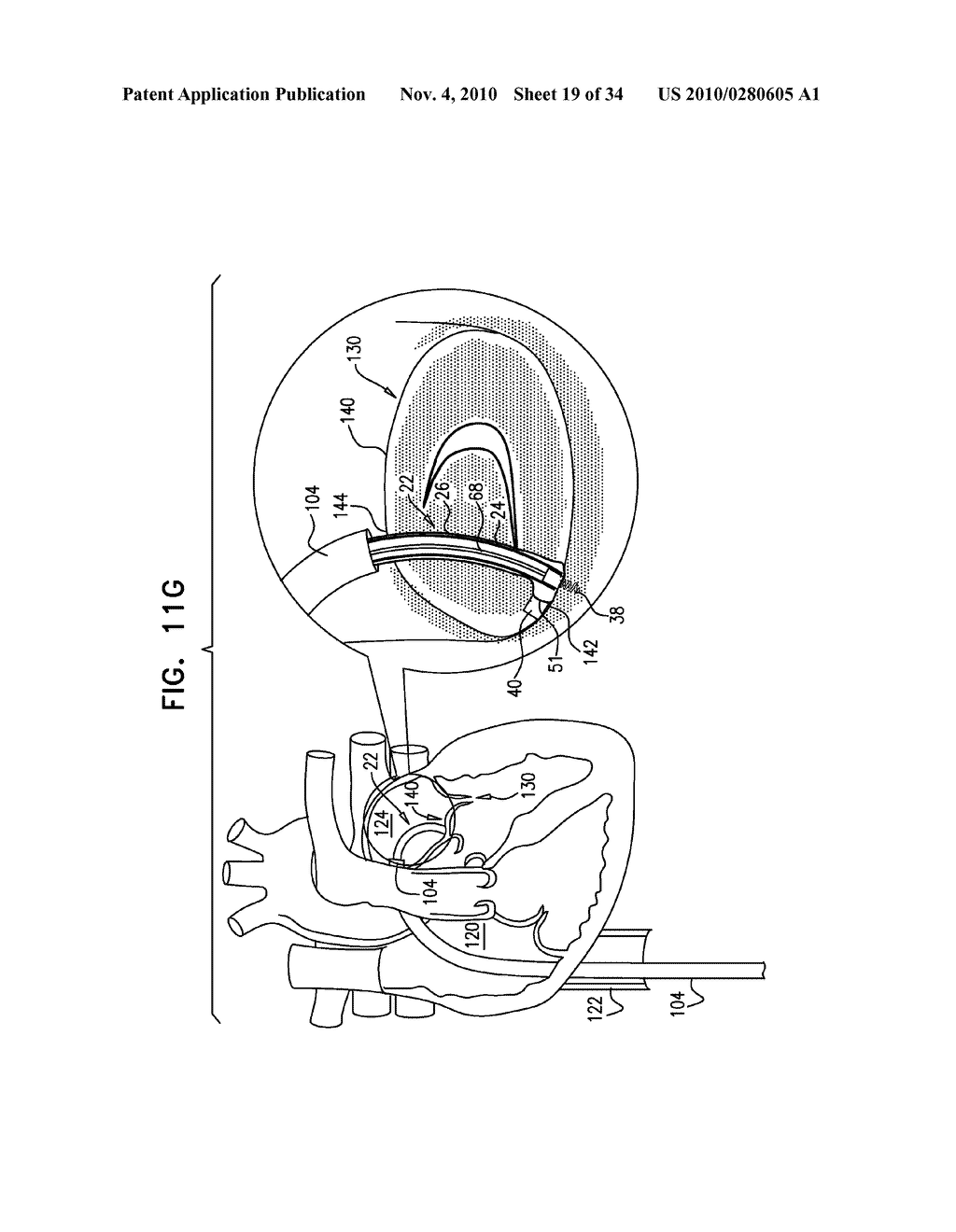 DEPLOYMENT TECHNIQUES FOR ANNULOPLASTY RING - diagram, schematic, and image 20