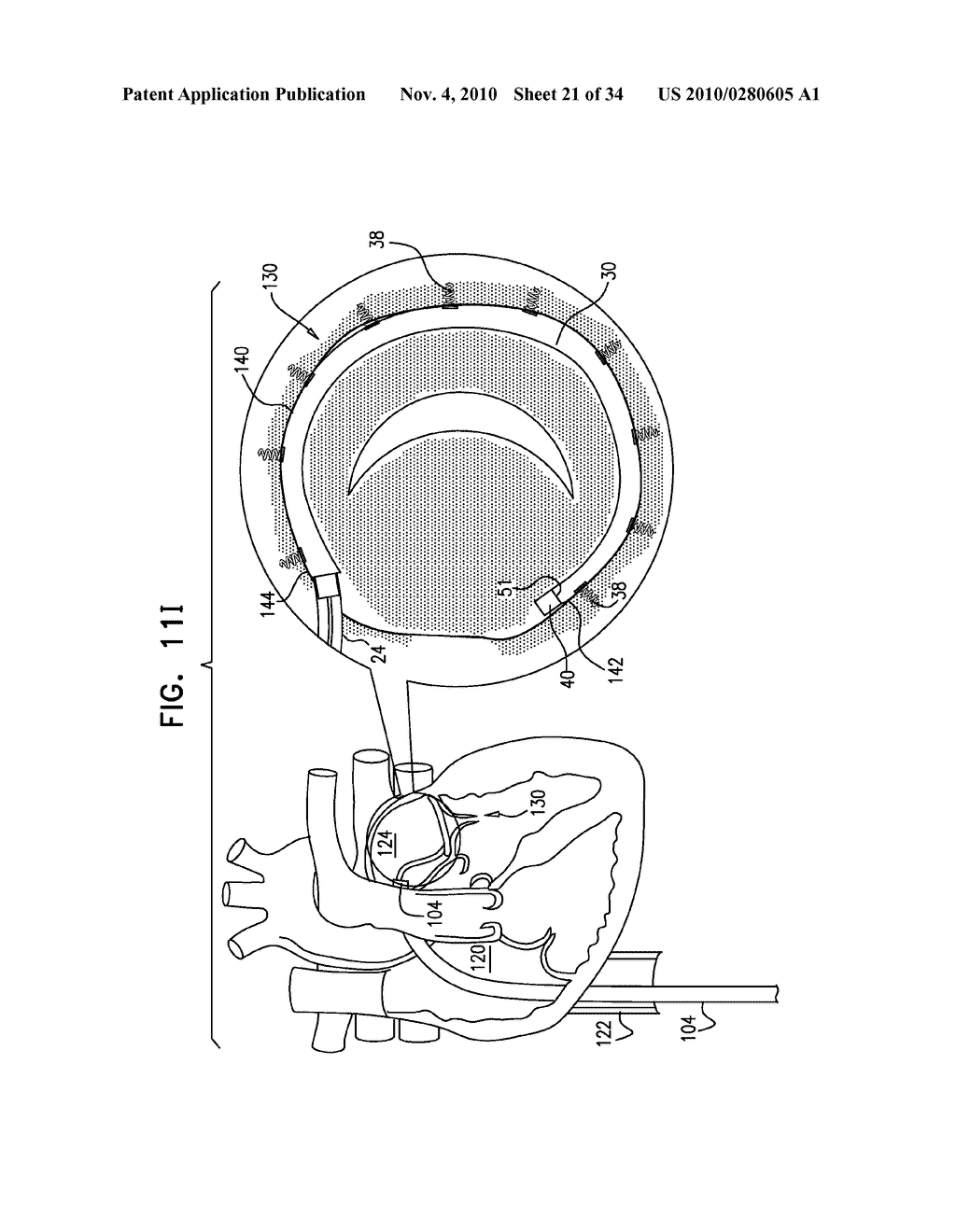 DEPLOYMENT TECHNIQUES FOR ANNULOPLASTY RING - diagram, schematic, and image 22