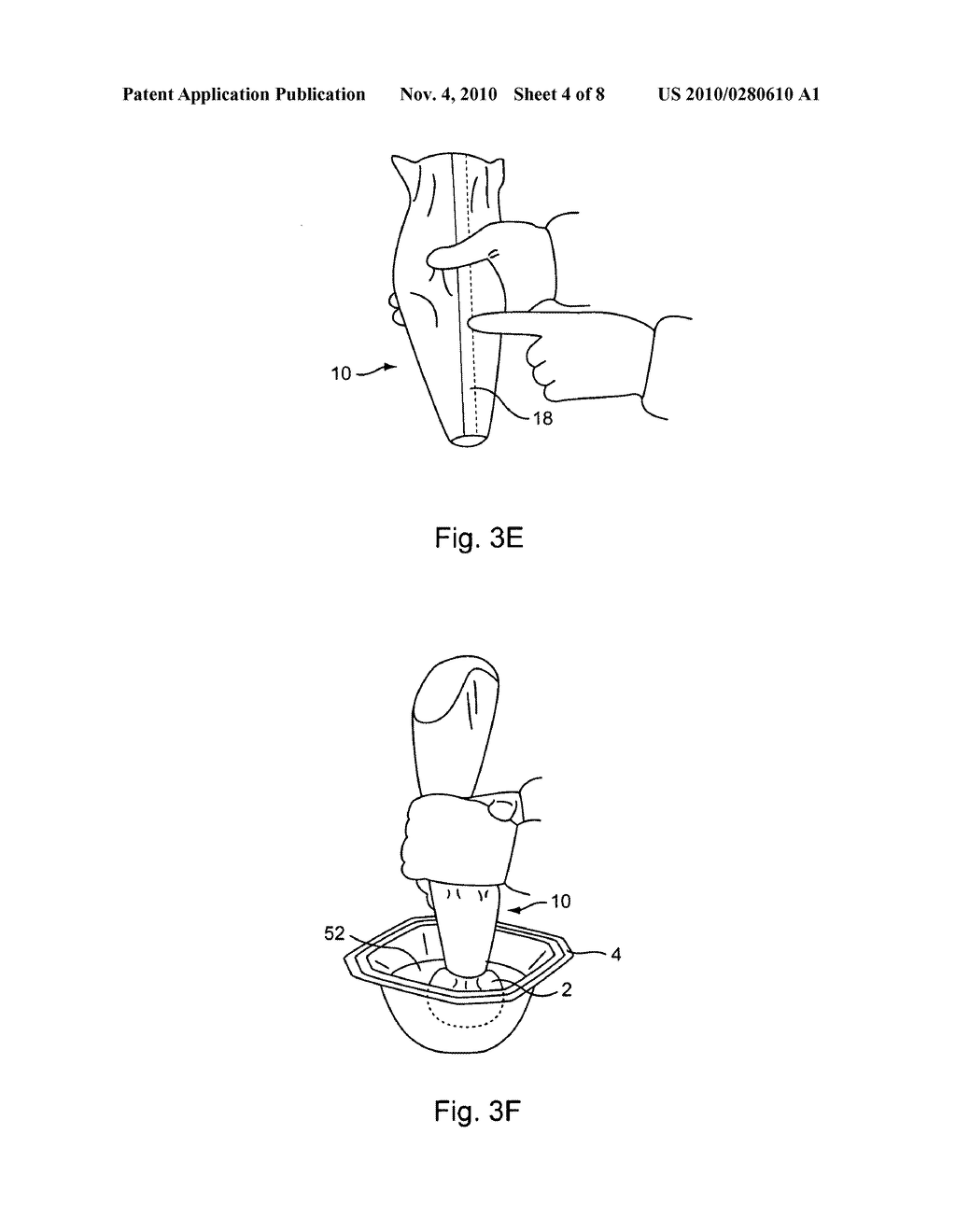 Silicone breast implant delivery - diagram, schematic, and image 05