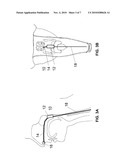 DEVICES AND METHODS FOR TREATING SLEEP DISORDERED BREATHING diagram and image