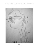 DEVICES AND METHODS FOR TREATING SLEEP DISORDERED BREATHING diagram and image