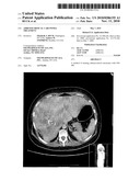 ADRENOCORTICAL CARCINOMA TREATMENT diagram and image