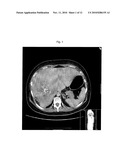 ADRENOCORTICAL CARCINOMA TREATMENT diagram and image