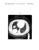 ADRENOCORTICAL CARCINOMA TREATMENT diagram and image