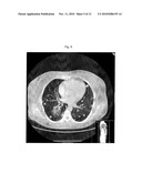 ADRENOCORTICAL CARCINOMA TREATMENT diagram and image