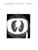 ADRENOCORTICAL CARCINOMA TREATMENT diagram and image