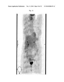 ADRENOCORTICAL CARCINOMA TREATMENT diagram and image