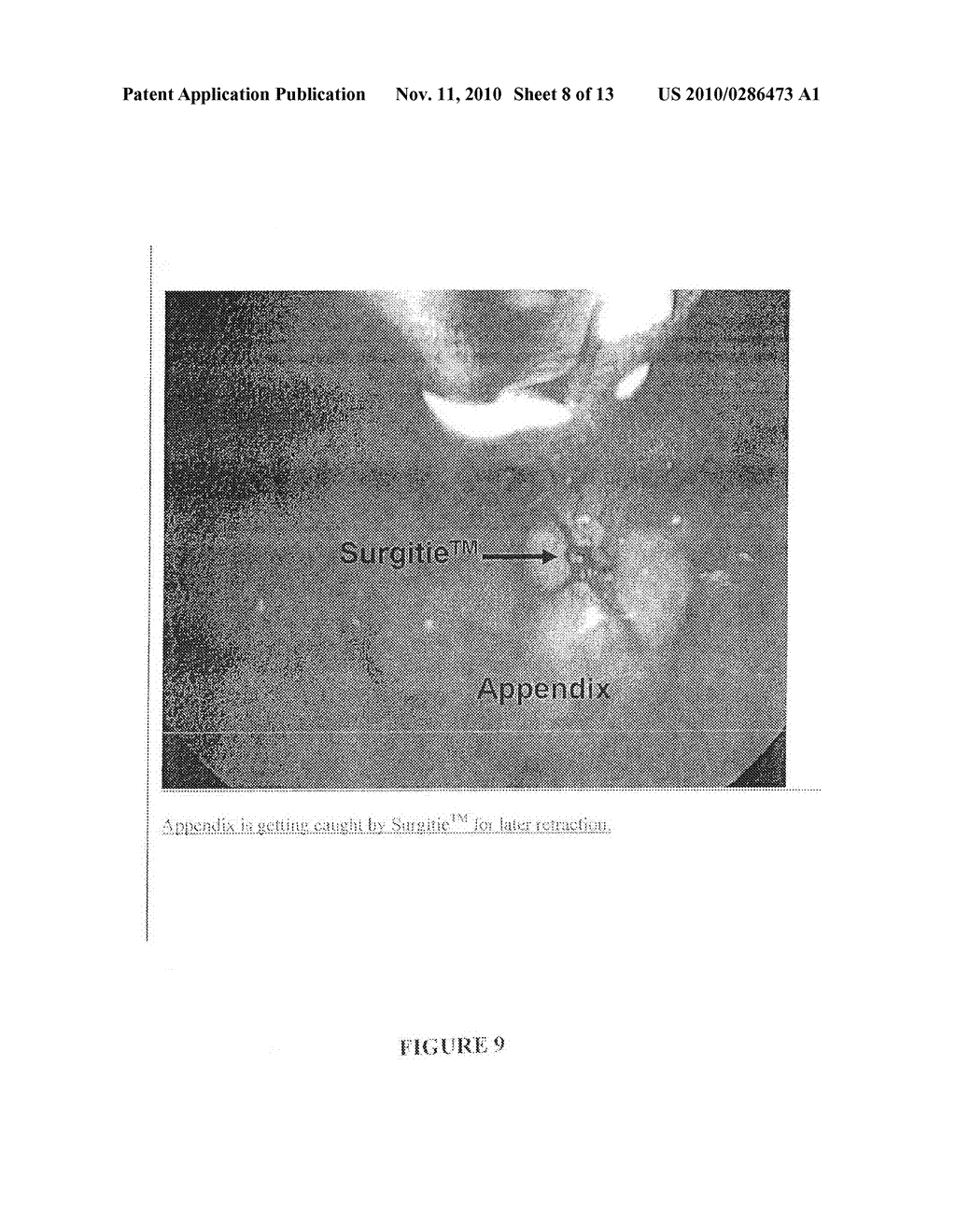 SUSPENSION/RETRACTION DEVICE FOR SURGICAL MANIPULATION - diagram, schematic, and image 09