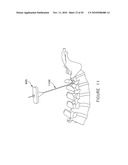 PEDICLE GUIDED RETRACTOR SYSTEM diagram and image