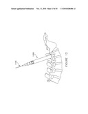 PEDICLE GUIDED RETRACTOR SYSTEM diagram and image