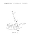 PEDICLE GUIDED RETRACTOR SYSTEM diagram and image