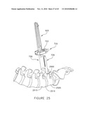 PEDICLE GUIDED RETRACTOR SYSTEM diagram and image