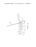 PEDICLE GUIDED RETRACTOR SYSTEM diagram and image