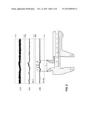 IMPLANTABLE P-WAVE DISPERSION DETECTOR diagram and image