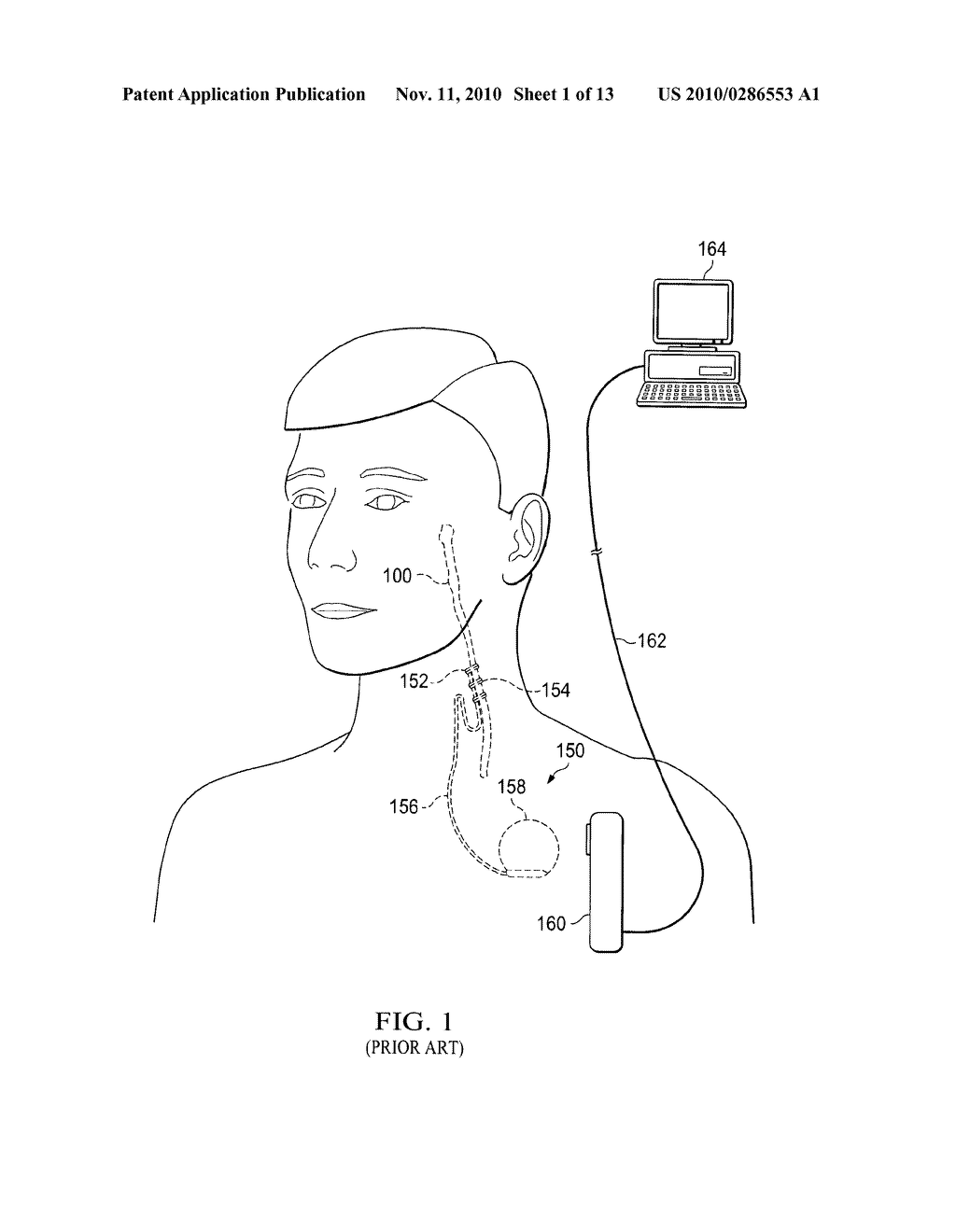 Devices and Methods for Screening of Vagal Nerve Stimulation - diagram, schematic, and image 02