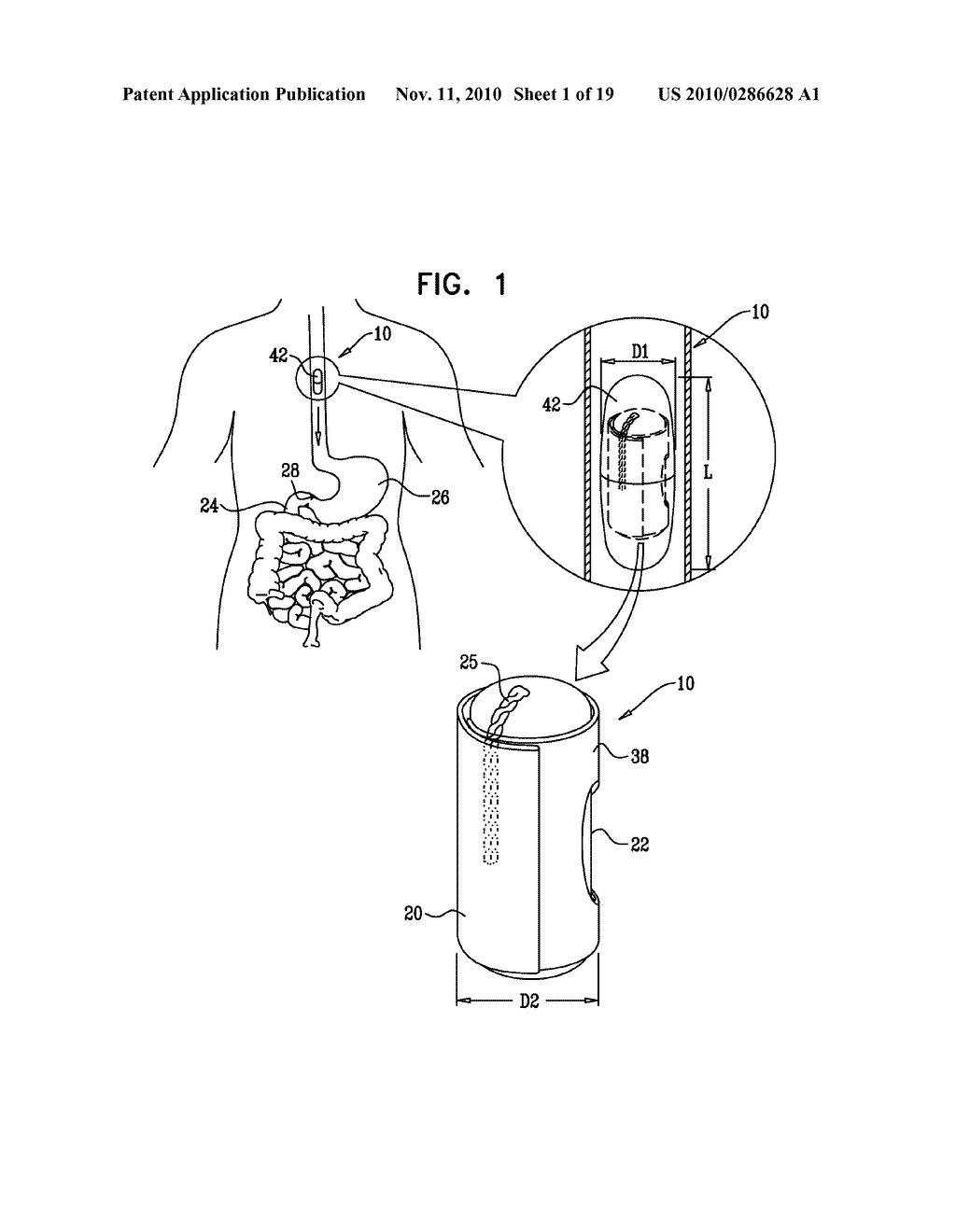 GASTRIC ANCHOR - diagram, schematic, and image 02