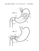 GASTRIC ANCHOR diagram and image