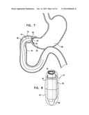 GASTRIC ANCHOR diagram and image