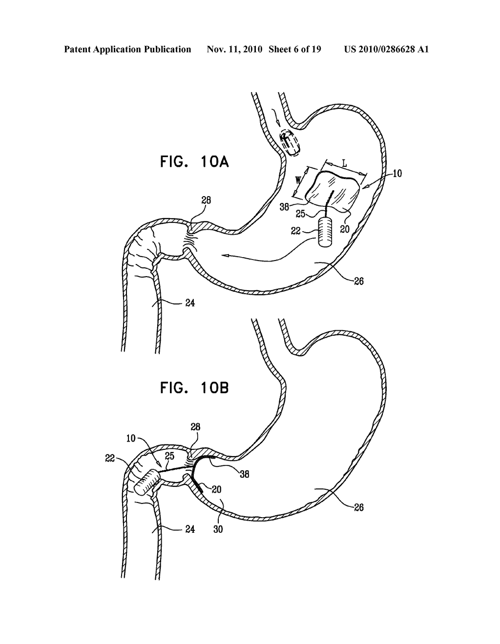 GASTRIC ANCHOR - diagram, schematic, and image 07