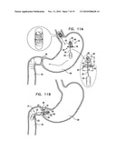 GASTRIC ANCHOR diagram and image