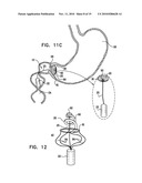 GASTRIC ANCHOR diagram and image