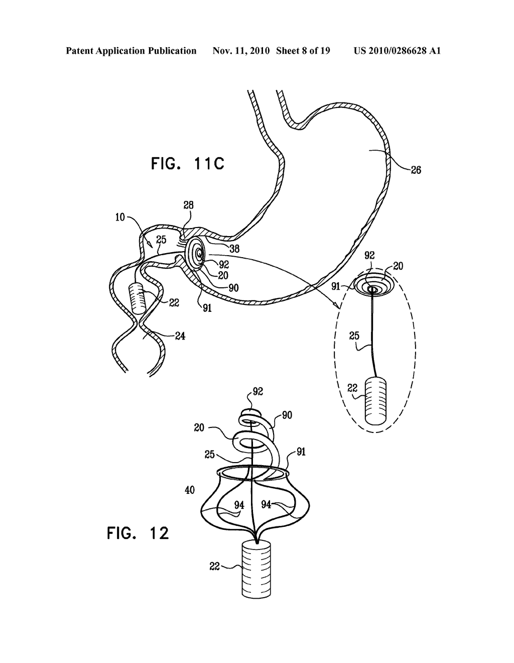 GASTRIC ANCHOR - diagram, schematic, and image 09